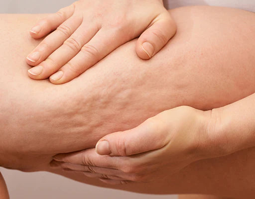 Celulitis