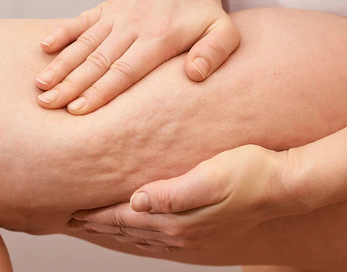 La celulitis no se va por más que hagas dieta, ejercicio o te pases cremas carísimas.